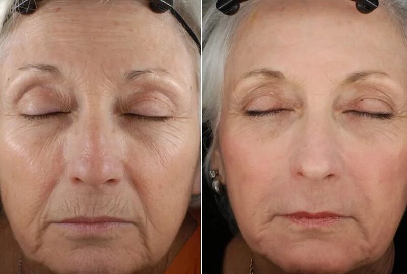The rejuvenation of a fractional rejuvenation