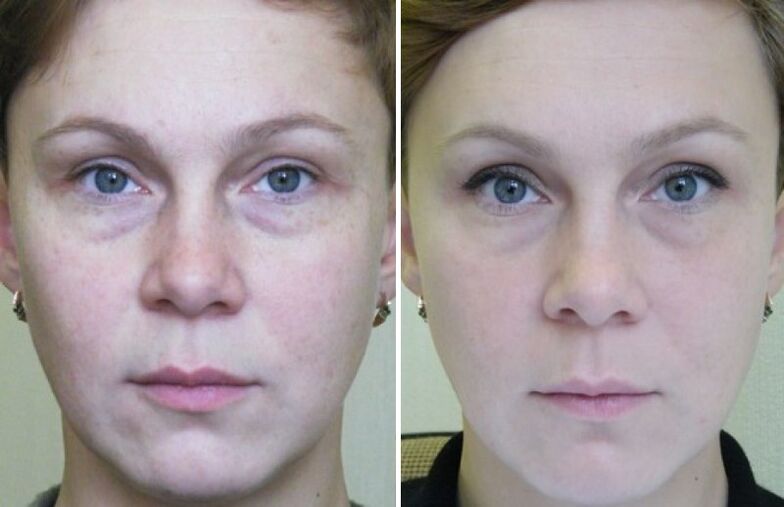 Photos before and after laser rejuvenation